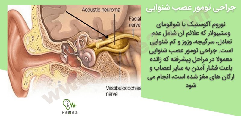جراحی تومور عصب شنوایی چگونه انجام می شود؟