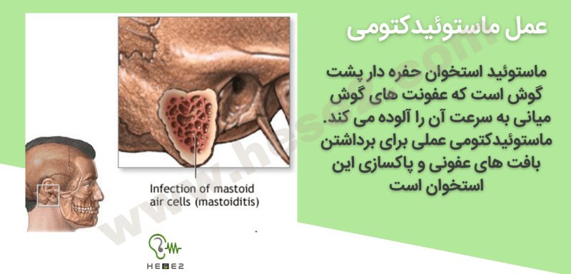 عمل ماستوئیدکتومی گوش میانی چگونه انجام می شود؟