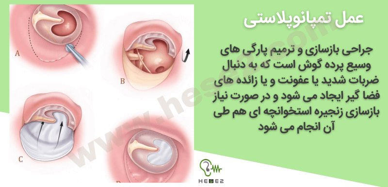 جراحی تمپاوپلاستی یا ترمیم پرده گوش چگونه انجام می شود؟