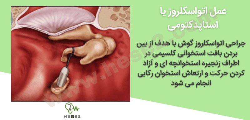 عمل استاپدکتومی گوش