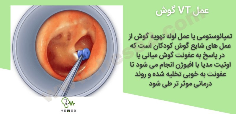 عمل vt یا لوله تهویه گوش میانی چگونه انجام می شود؟