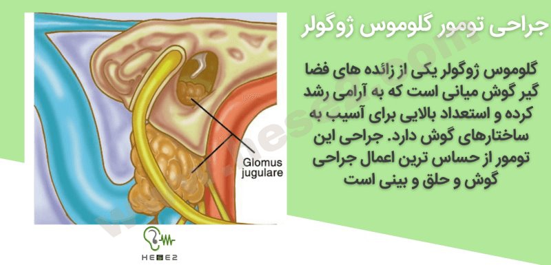 جراحی تومور گلوموس ژوگولر چگونه انجام می شود؟