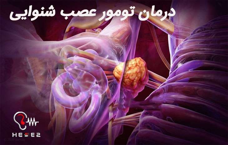 همه راه های درمان تومور عصب شنوایی یا نوروم آکوستیک