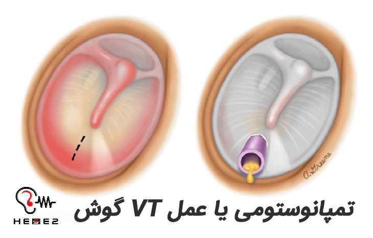 جراحی تمپانوستومی یا عمل vt گوش در چه مواردی انجام می شود؟